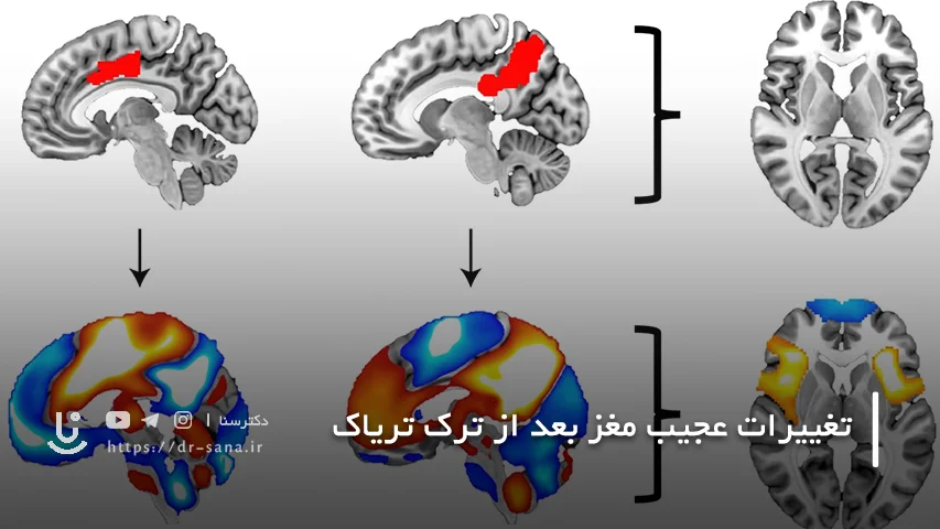 تغییرات مغز بعد از ترک تریاک چیست؟